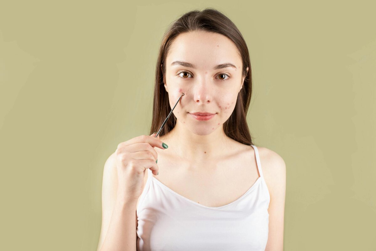 Acne Prone Skin